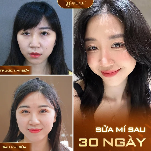 giai-phap-khac-phuc-mi-mat-hong-an-toan