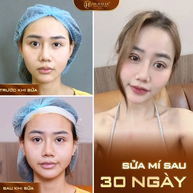 giai-phap-khac-phuc-mi-mat-hong-an-toan