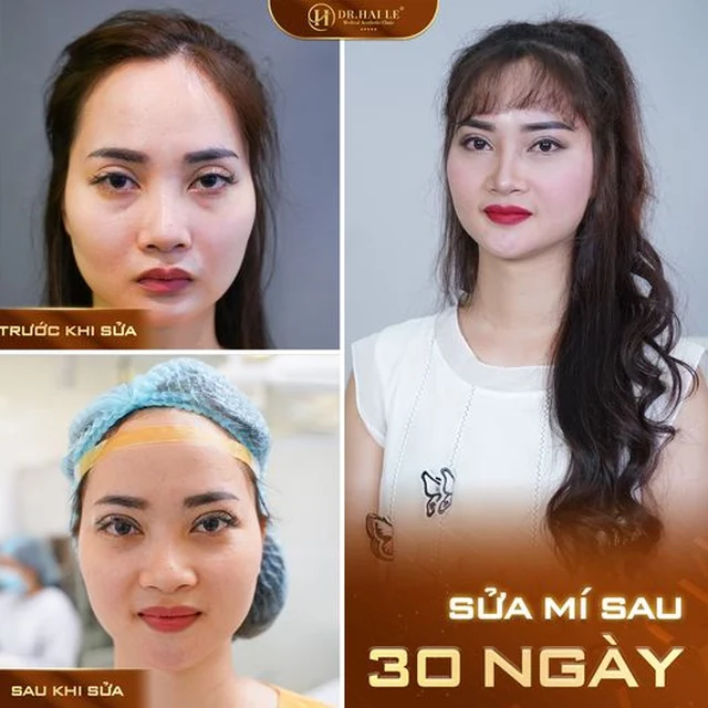 giai-phap-khac-phuc-mi-mat-hong-an-toan