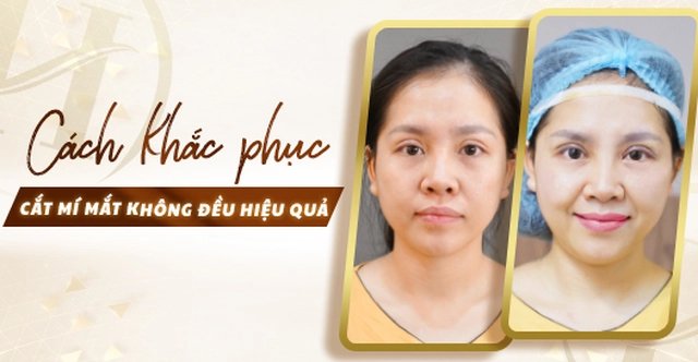 Cách khắc phục cắt mí mắt không đều hiệu quả? Cách khắc phục cắt mí mắt không đều hiệu quả?