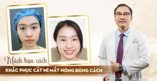Mách bạn cách khắc phục cắt mí mắt hỏng đúng cách? Mách bạn cách khắc phục cắt mí mắt hỏng đúng cách?