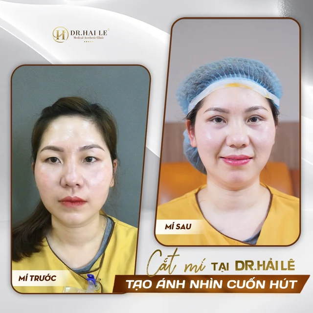 khoi-phuc-ve-dep-cho-doi-mat-voi-phau-thuat-tai-tao-mi-mat