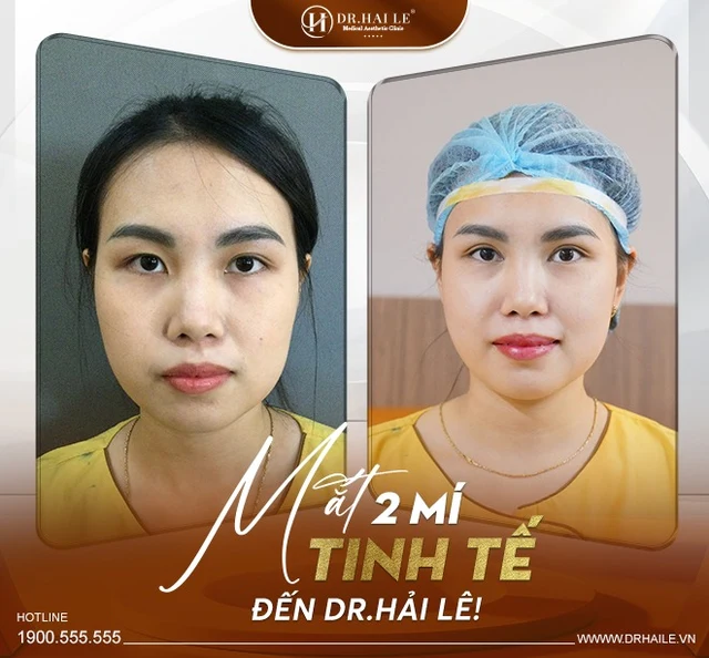 khoi-phuc-ve-dep-cho-doi-mat-voi-phau-thuat-tai-tao-mi-mat