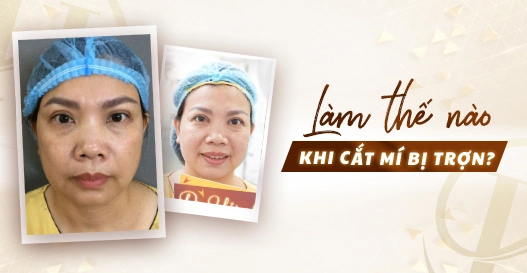 Làm thế nào khi cắt mí bị trợn?