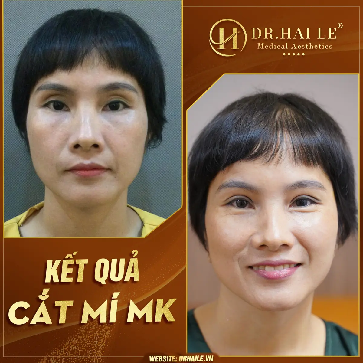 mi-nhieu-nep-mi