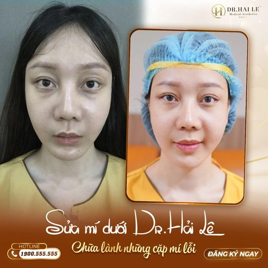 sua-mi-duoi