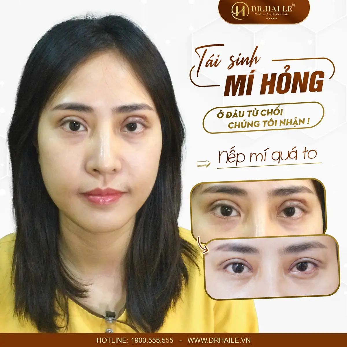 sua-mi-hong