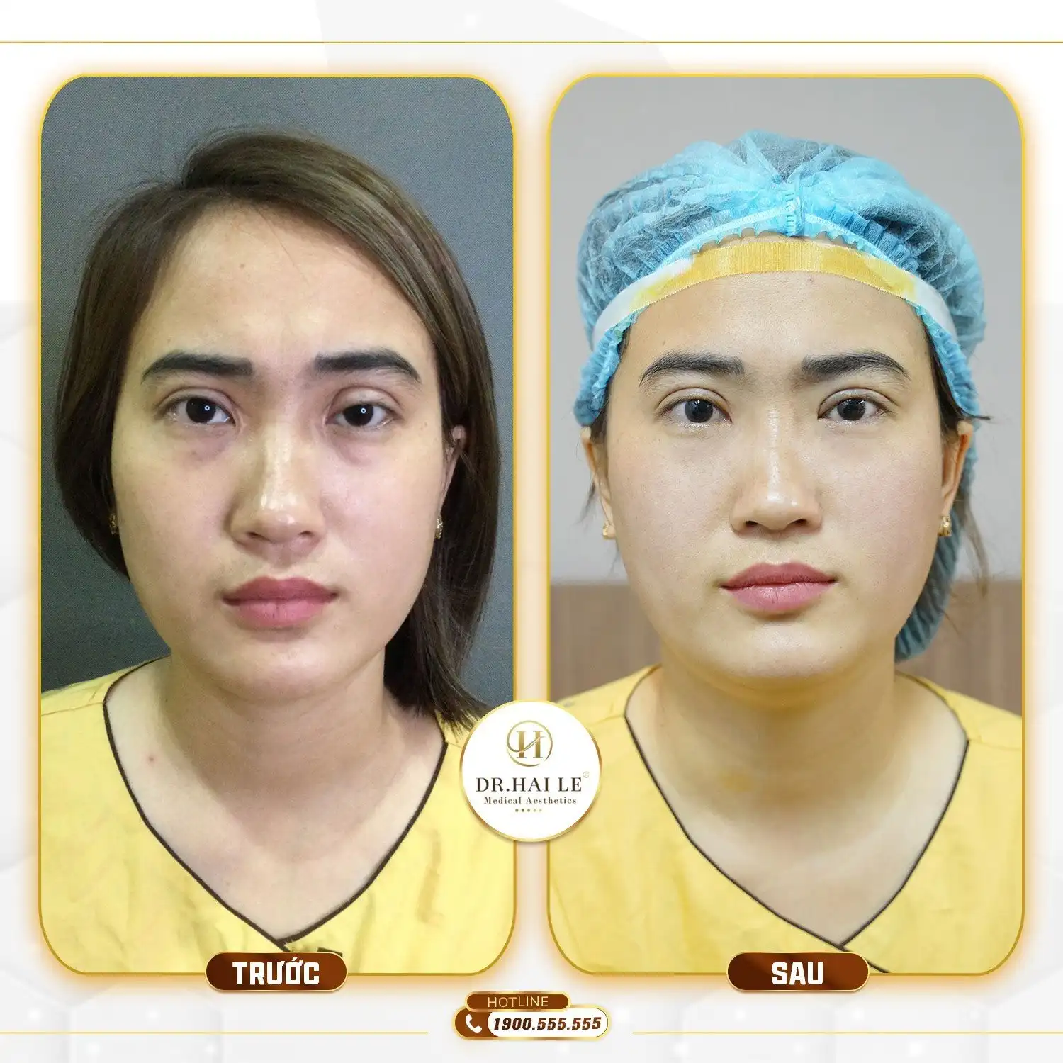 sua-mi-hong