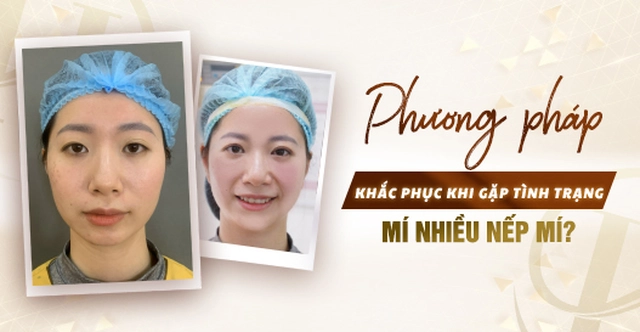 Phương pháp khắc phục khi gặp tình trạng mí nhiều nếp mí? Phương pháp khắc phục khi gặp tình trạng mí nhiều nếp mí?