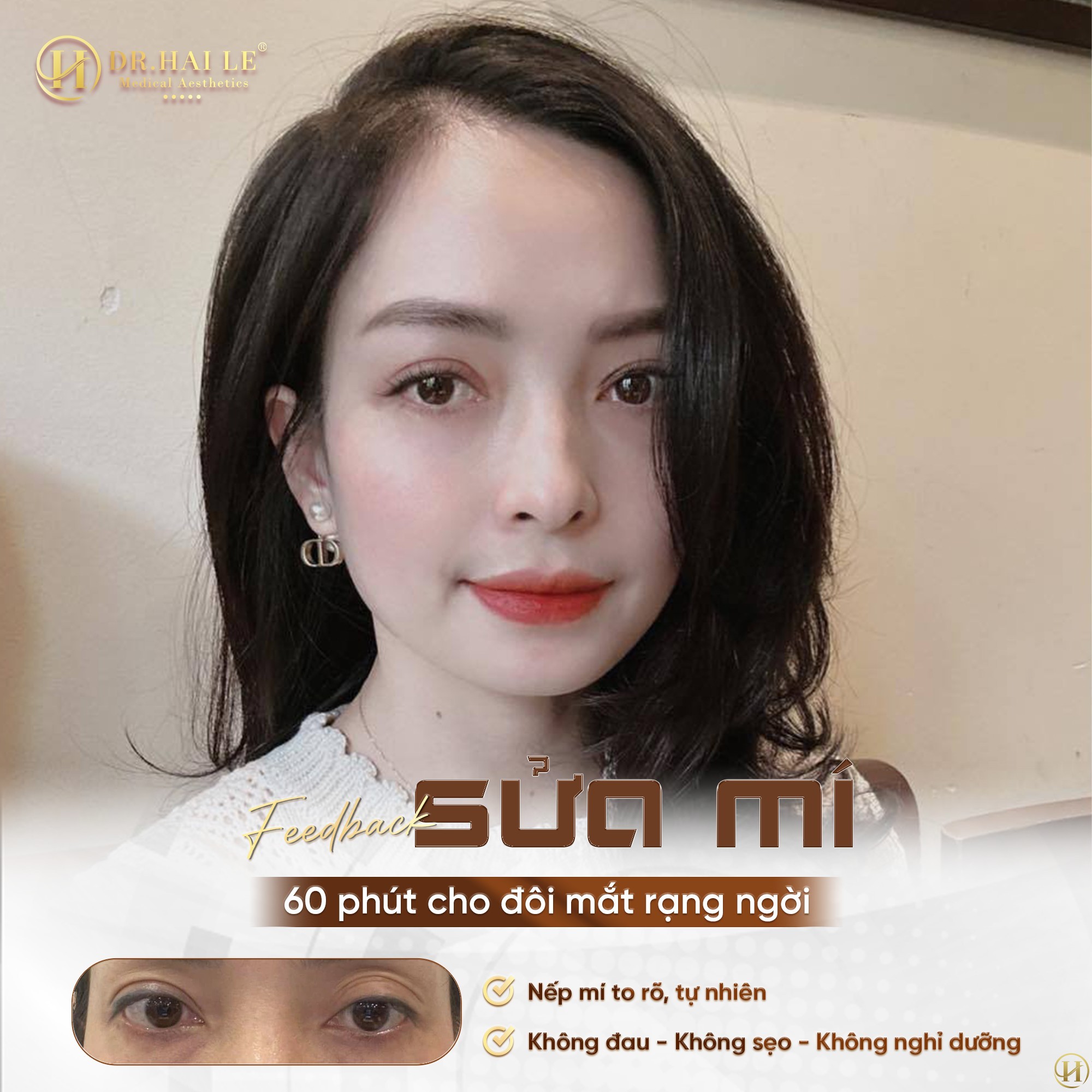 nhan-mi-loi-co-sua-duoc-khong