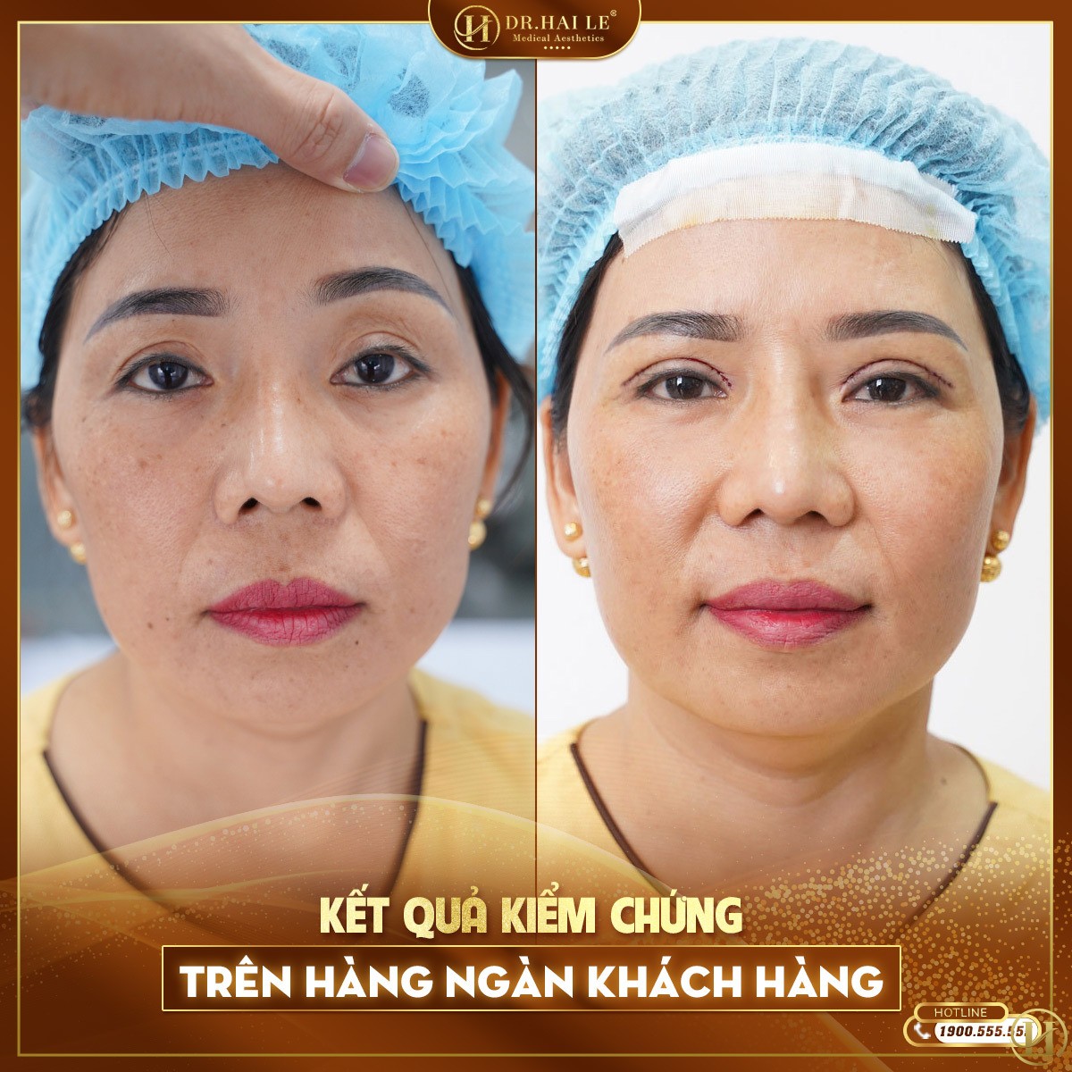 nhan-mi-loi-co-sua-duoc-khong