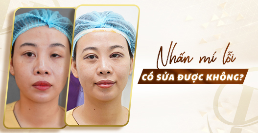 Nhấn mí lỗi có sửa được không?