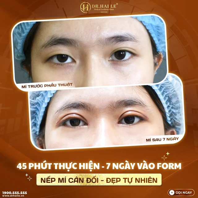 phau-thuat-cat-mi-mat