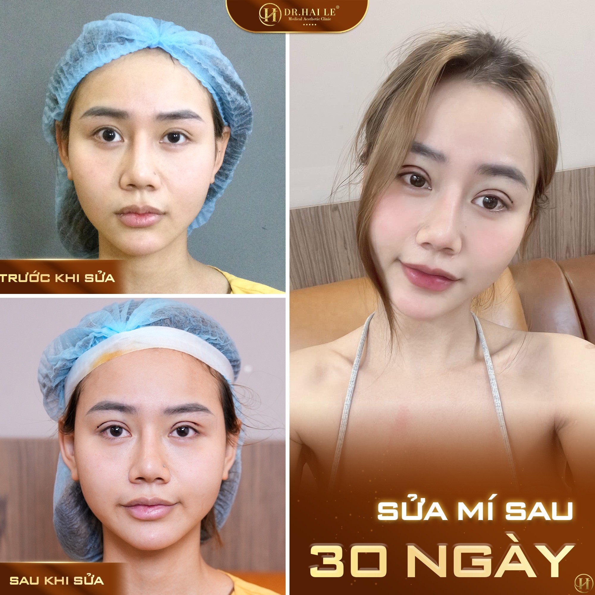 phau-thuat-tham-my-mat-bi-hong-nguyen-nhan-va-hau-qua