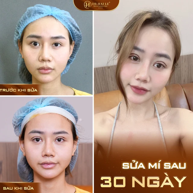 nhan-mi-bi-hong-dung-lo-lang-da-co-giai-phap-hieu-qua