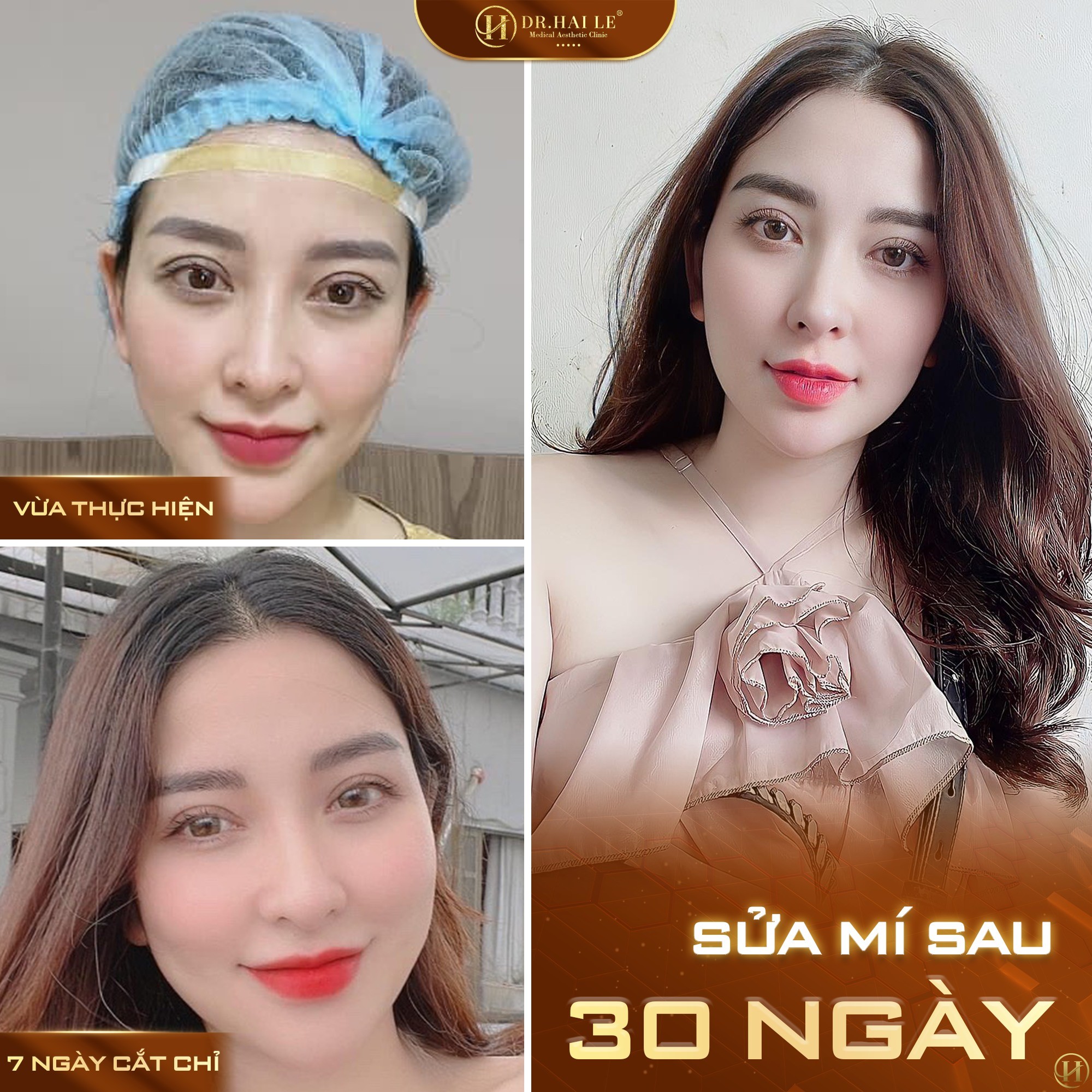phau-thuat-tham-my-mat-bi-hong-nguyen-nhan-va-hau-qua