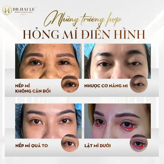 sua-mi-mat-tu-nhien
