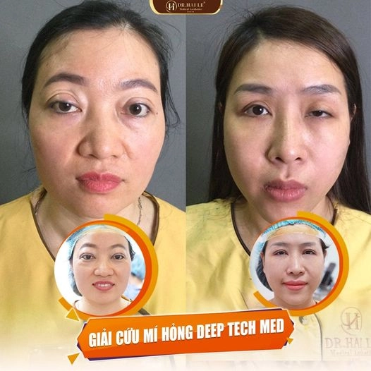 sua-mi-mat-lech