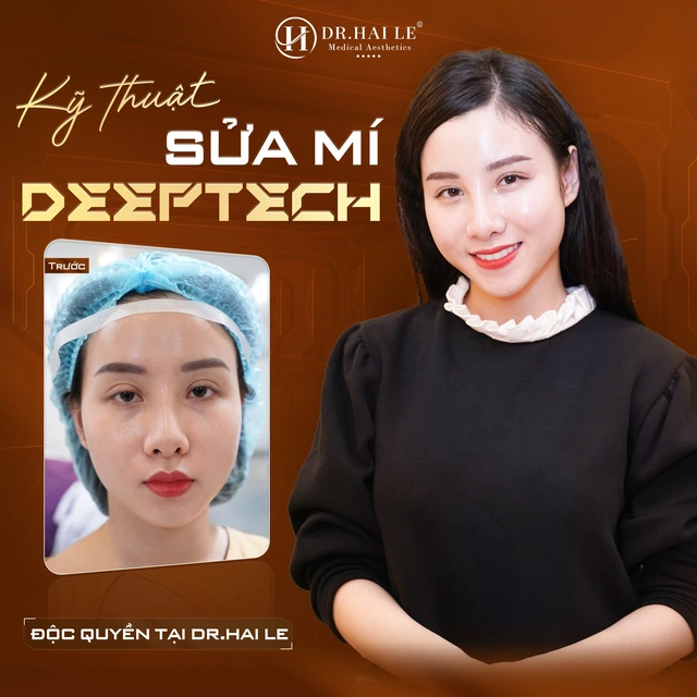 phau-thuat-sua-mi
