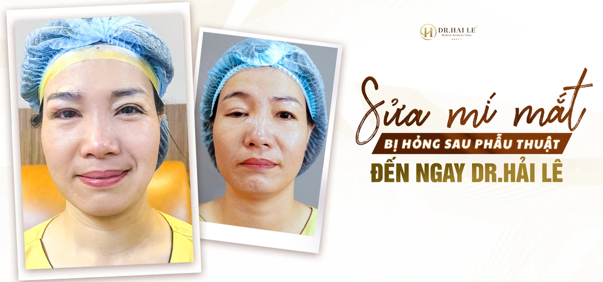 sua-mi-hong