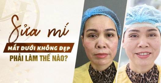 Sửa mí mắt dưới không đẹp phải làm thế nào?