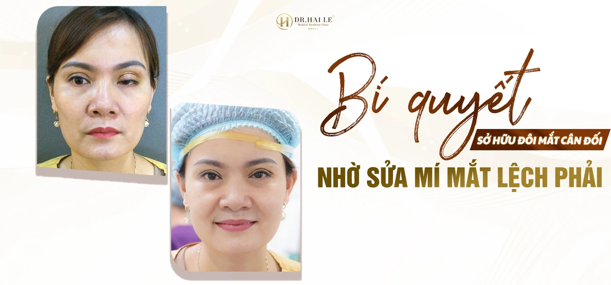 sua-mi-mat-lech-phai