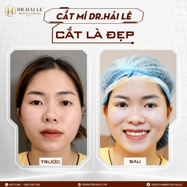 sua-mat-1-mi-thanh-2-mi-hieu-qua-lau-dai-tai-drhai-le