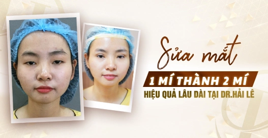 Sửa mắt 1 mí thành 2 mí hiệu quả lâu dài tại Dr.Hải Lê