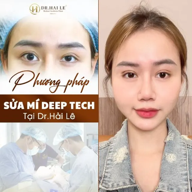 sua-mi-deep-tech-tai-drhai-le-tai-sinh-ve-dep-cho-cua-so-tam-hon
