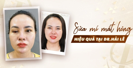 Sửa mí mắt hỏng hiệu quả tại Dr.Hải Lê?