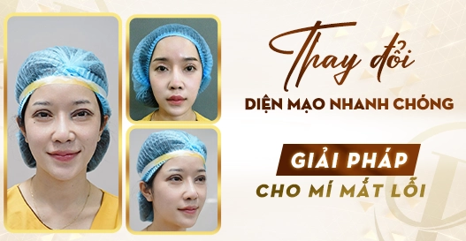 Thay đổi diện mạo nhanh chóng: Giải pháp cho mí mắt lỗi