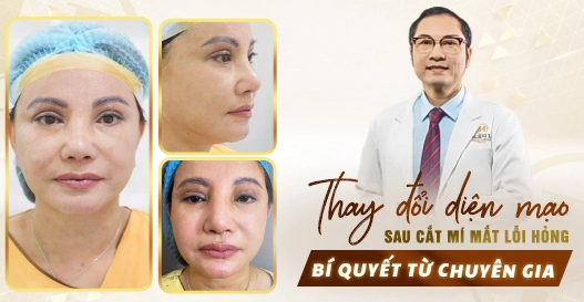 Thay đổi diện mạo sau cắt mí mắt lỗi hỏng: Bí quyết từ chuyên gia Thay đổi diện mạo sau cắt mí mắt lỗi hỏng: Bí quyết từ chuyên gia