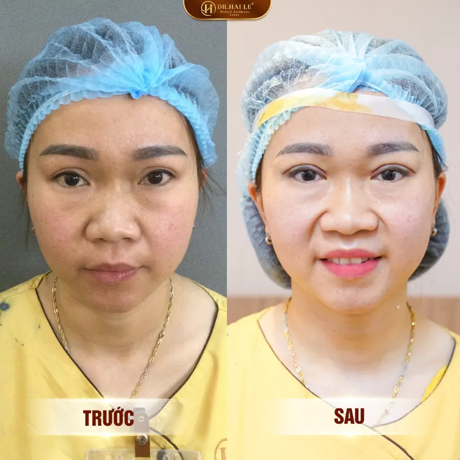 sua-mi-mat-khong-dau