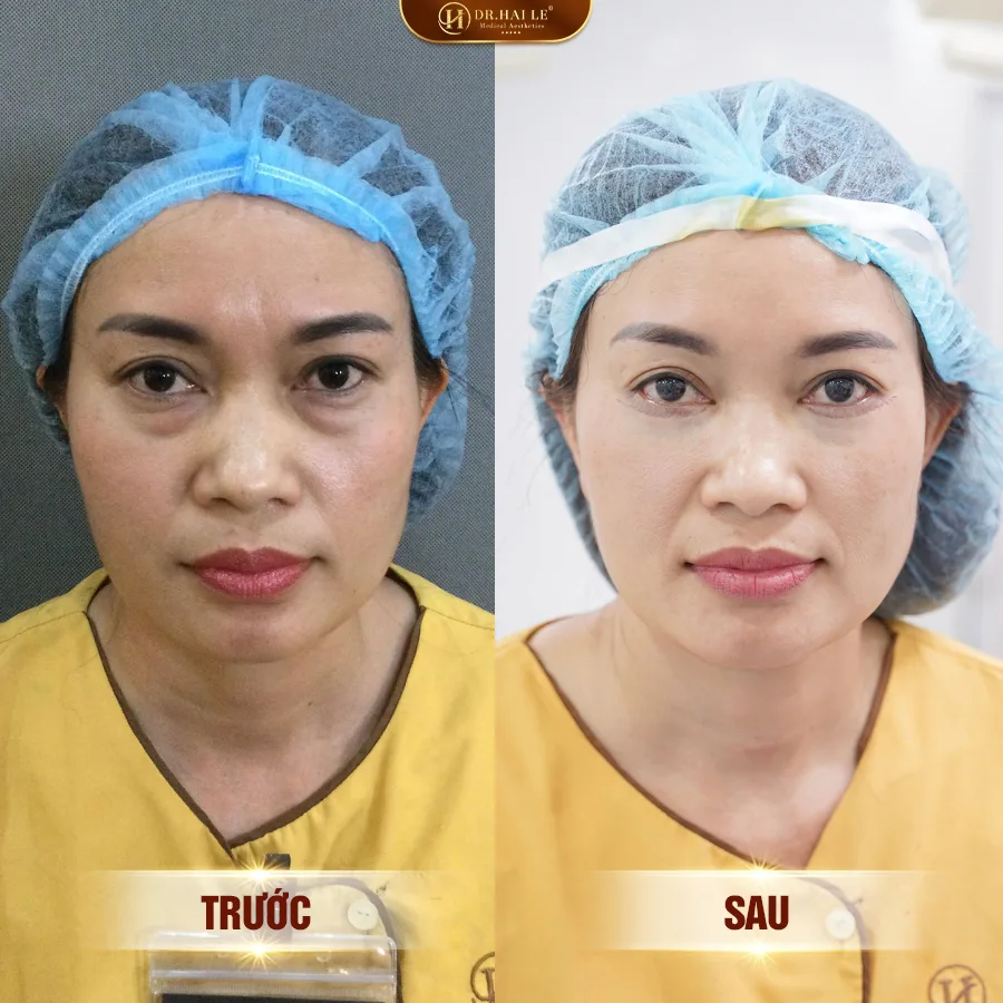 tham-my-mat-duoi