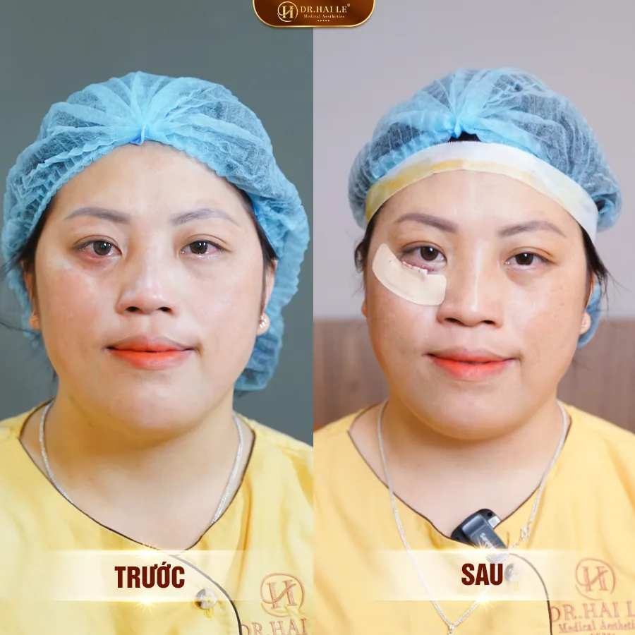 tham-my-mat-duoi