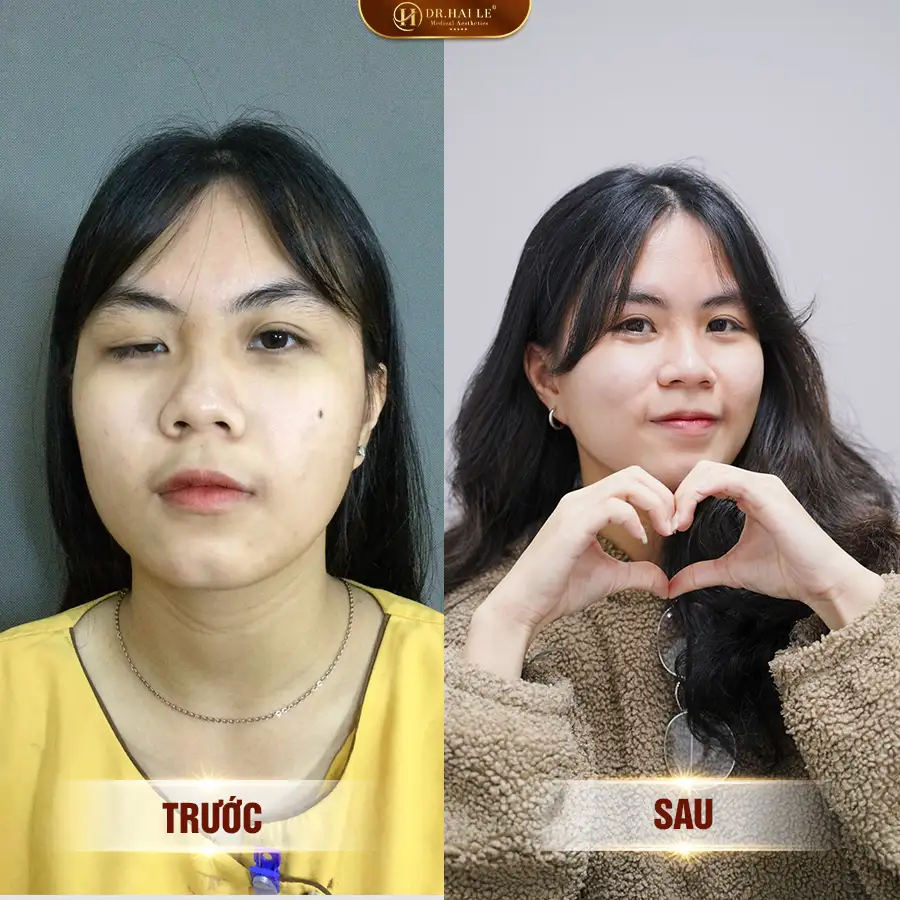 sua-mi-mat-sup-mi