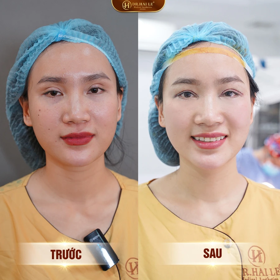 sua-mi-mat-mat-tu-nhien