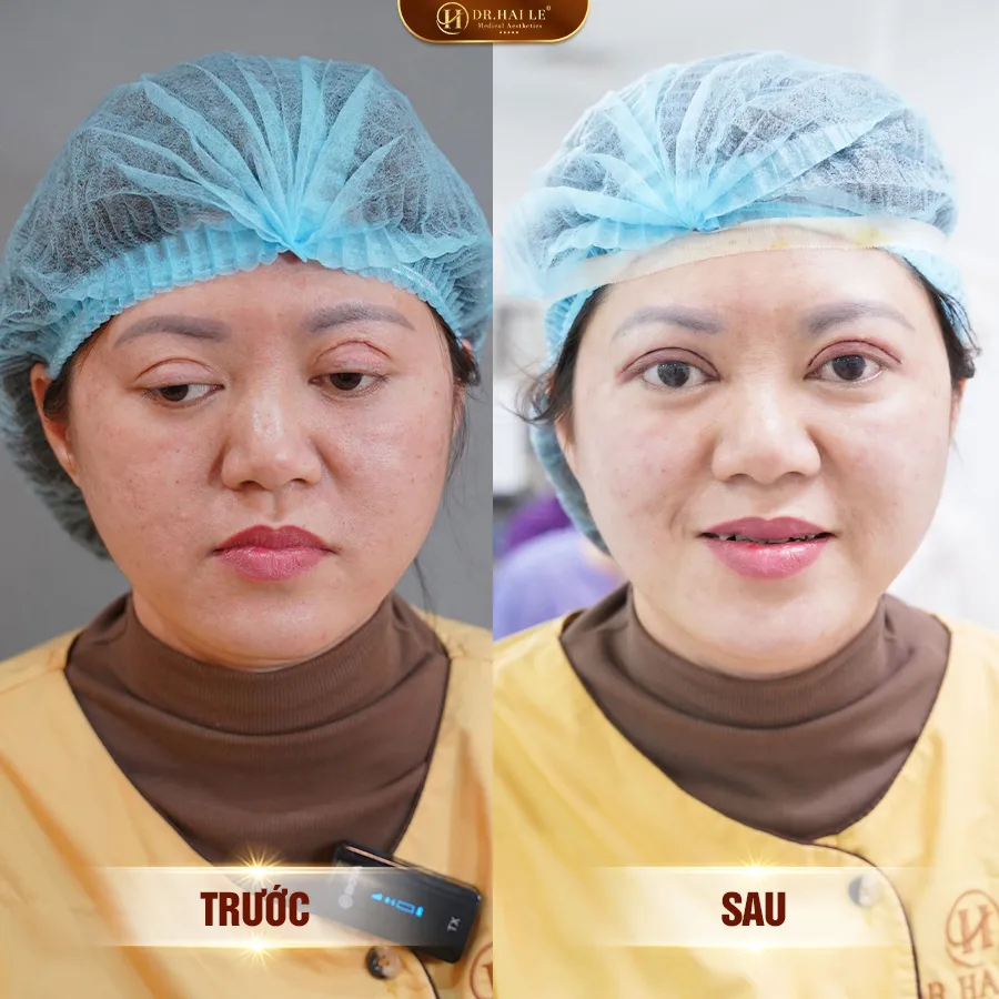sua-mi-mat-lech-phai
