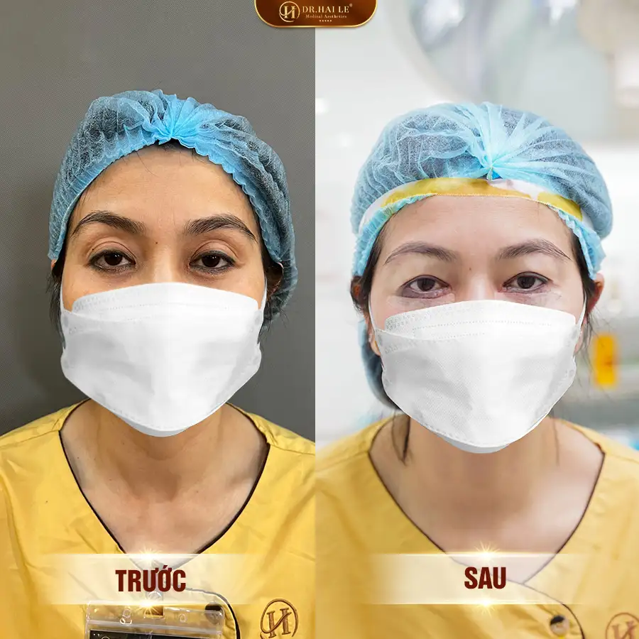 sua-mi-duoi