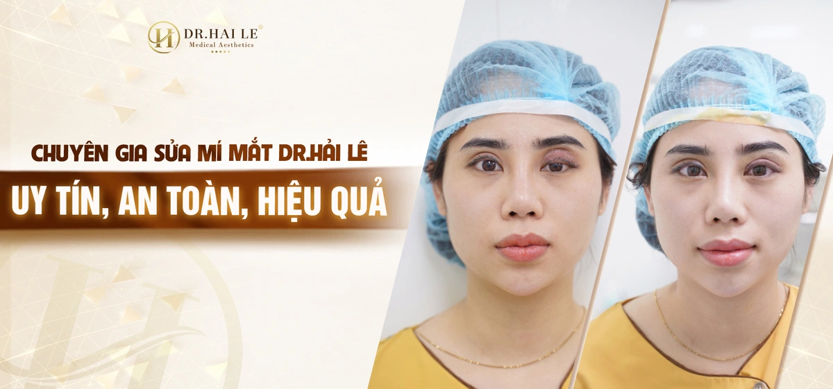 Chuyên gia sửa mí mắt Dr.Hải Lê - Uy tín, an toàn, hiệu quả Chuyên gia sửa mí mắt Dr.Hải Lê - Uy tín, an toàn, hiệu quả