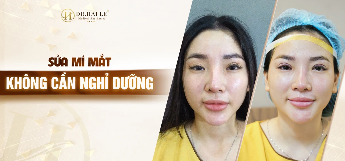 sua-mi-mat-khong-can-mghi-duong