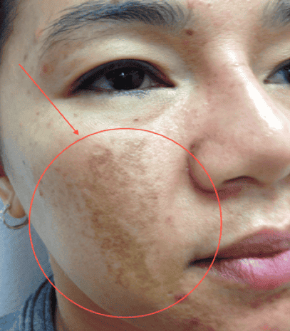  Bước 2: Soi da bằng công nghệ cao 