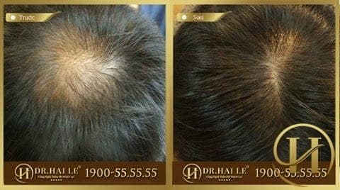 nên cấy tóc sinh học hay cấy tóc tự thân?