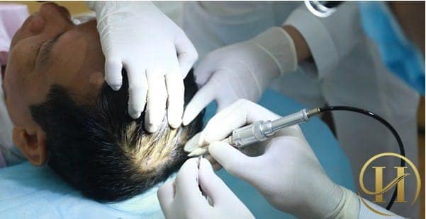 Cấy tóc sinh học bằng BioFibre có để lại sẹo không?