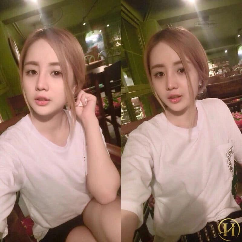 Sự khác biệt của phương pháp nâng mũi Demi-5D Dr. Hải Lê