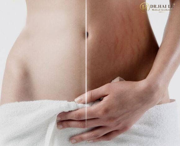 ảnh trước sau điều trị rạn da bằng Plasma C-8D
