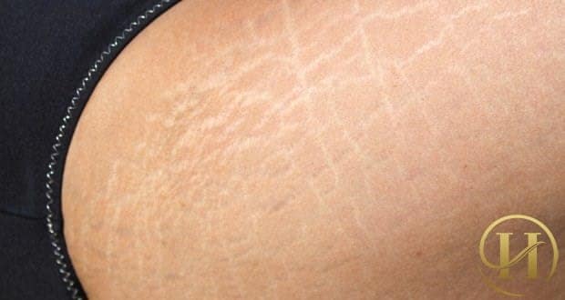 ai có thể điều trị rạn da bằng Plasma C-8D