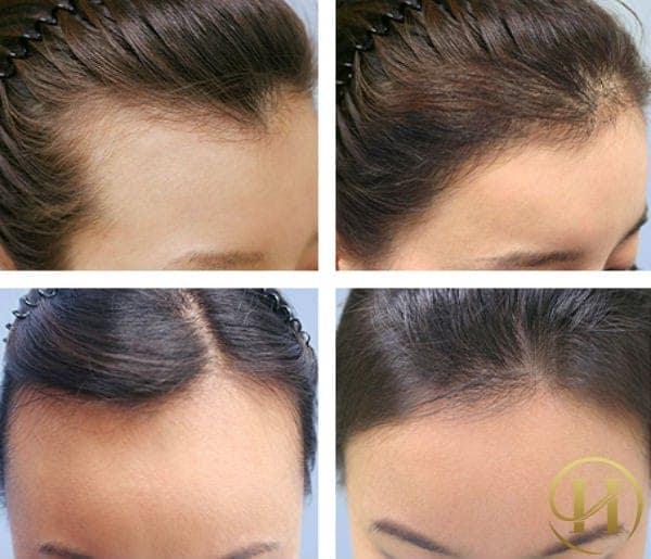 Cấy tóc sinh học có phải kiêng khem gì không?