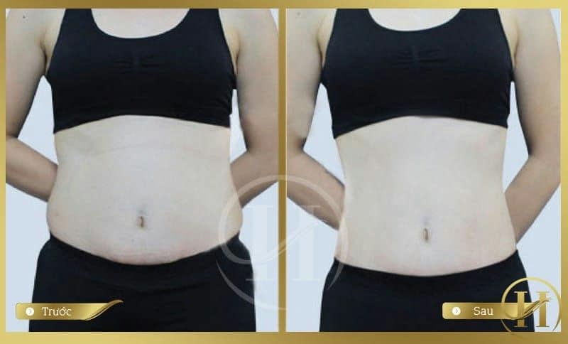 Kết quả trước và sau khi điều trị bằng máy giảm mỡ bụng New Cavi-lipo