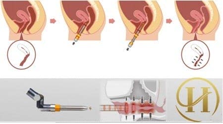 Thu gọn trẻ hóa âm đạo bằng laser 